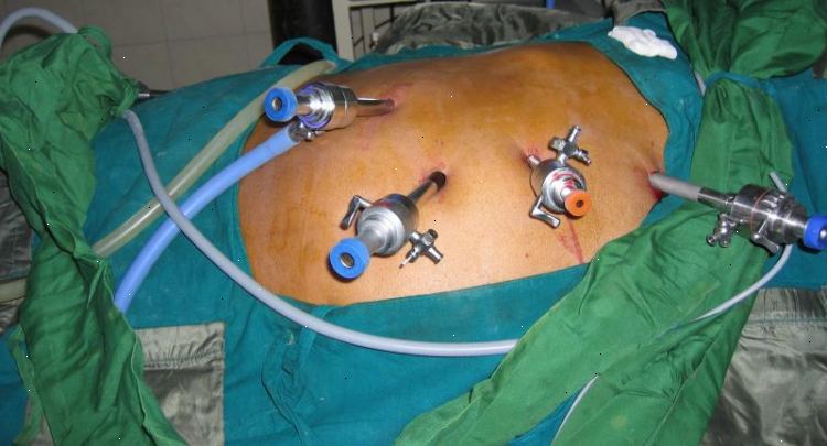 reduccion de estomago por laparoscopia en madrid